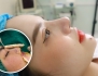  Trung bì mỡ là gì? Giải pháp sửa mũi số 1 “giải cứu mũi hỏng, nhiễm trùng, hoại tử”