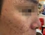 Top 3 Công Nghệ Điều Trị Sẹo Rỗ An Toàn, Hiệu Quả Cao Tại Phòng Khám Da Liễu Thẩm Mỹ Thiên Trường