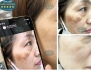 Top 5 Liệu Trình Điều Trị Nám Da Được Chuyên Gia Da Liễu Khuyên Dùng