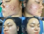 Top 4 Công Nghệ Trị Mụn Tốt Nhất Hiện Nay – Giải Pháp Da Sáng Mịn Không Tì Vết