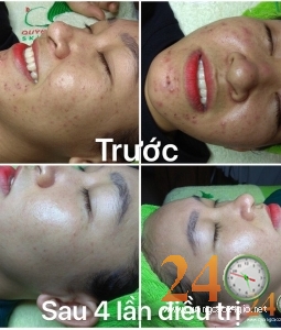 SPA TRỊ MỤN UY TÍN NHẤT QUẬN 12