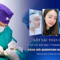 Tự ti vì mũi tẹt, đầu mũi to cô giáo quyết tâm đi nâng mũi sau 7 tháng sinh con