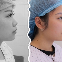 Hành trình lột xác hoàn toàn của cô gái 28 tuổi khi nâng mũi tại Thẩm mỹ viện Hương Giang