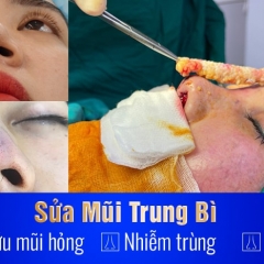 Sửa mũi trung bì - Giải pháp giải cứu mũi hỏng, nhiễm trùng, hoại tử
