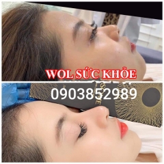 Spa Tiêm Filler Uy Tín Quận 6 - Spa Tiêm Filler Uy Tín Quận Tân Phú