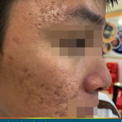 Top 3 Công Nghệ Điều Trị Sẹo Rỗ An Toàn, Hiệu Quả Cao Tại Phòng Khám Da Liễu Thẩm Mỹ Thiên Trường