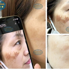 Top 5 Liệu Trình Điều Trị Nám Da Được Chuyên Gia Da Liễu Khuyên Dùng