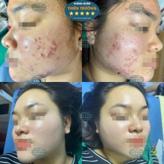 Top 4 Công Nghệ Trị Mụn Tốt Nhất Hiện Nay – Giải Pháp Da Sáng Mịn Không Tì Vết