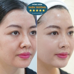 Top 10 Công Nghệ Trẻ Hóa Da Không Xâm Lấn Hiệu Quả Nhất