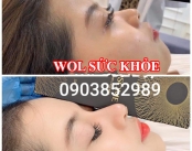 Spa Tiêm Filler Uy Tín Quận 6 - Spa Tiêm Filler Uy Tín Quận Tân Phú