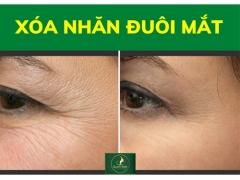 Xóa Nhăn Đuôi Mắt, Xóa Bọng Mắt, Xóa Thâm Mắt Hiệu Quả Tại Quận 12 Gần Gò Vấp Hocmon Củ Chi, Bình Dương, Tphcm